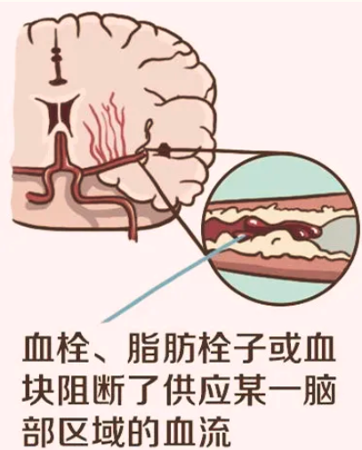 脑血栓卡通图片图片